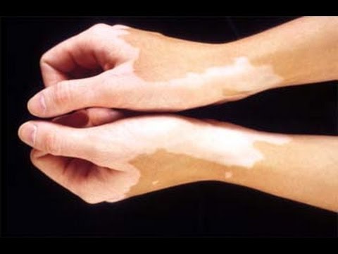Dr. Rajesh Khandelwal, Astha Clinic discusses the reasons of White Spots or Vitiligo on skin