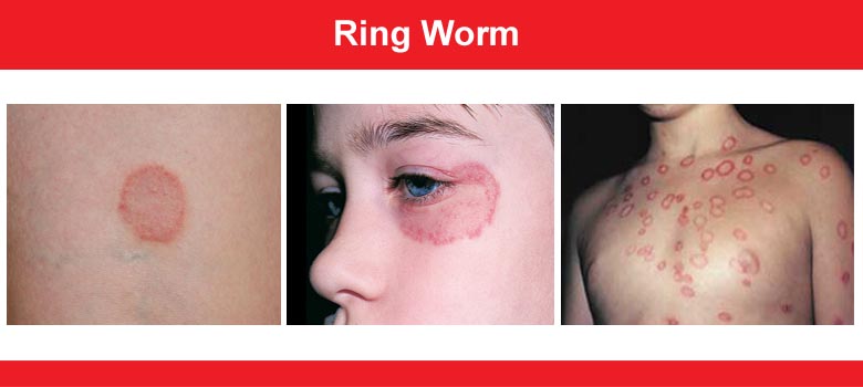 Free Vector | Informative symptoms of ringworm