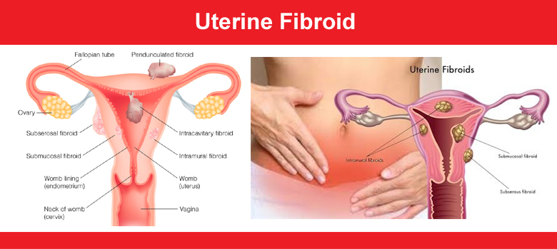 Dr. Ranu Gupta, Astha Clinic, Ajmer explains Uterine Fibroid